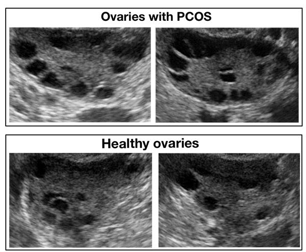 The Effectiveness of CNN in Evaluating Ultrasound Image Datasets: Diagnosing Polycystic Ovary Syndrome (PCOS) as an Example